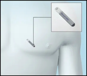  心源“擒凶” 探索晕厥病因?——我院成功开展首例心脏事件记录仪植入术